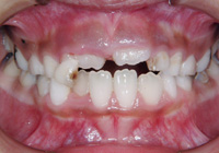 上の前歯2本と下の前歯4本が永久歯