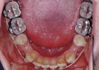 歯を抜いて治療した例　その1　治療途中03