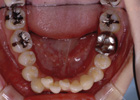 歯を抜いて治療した例　その2　治療前03