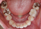 歯を抜いて治療した例　その2　治療後03