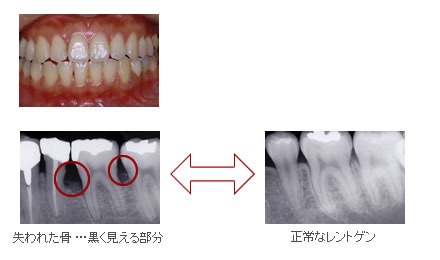 歯周病が悪化した患者さんのレントゲン